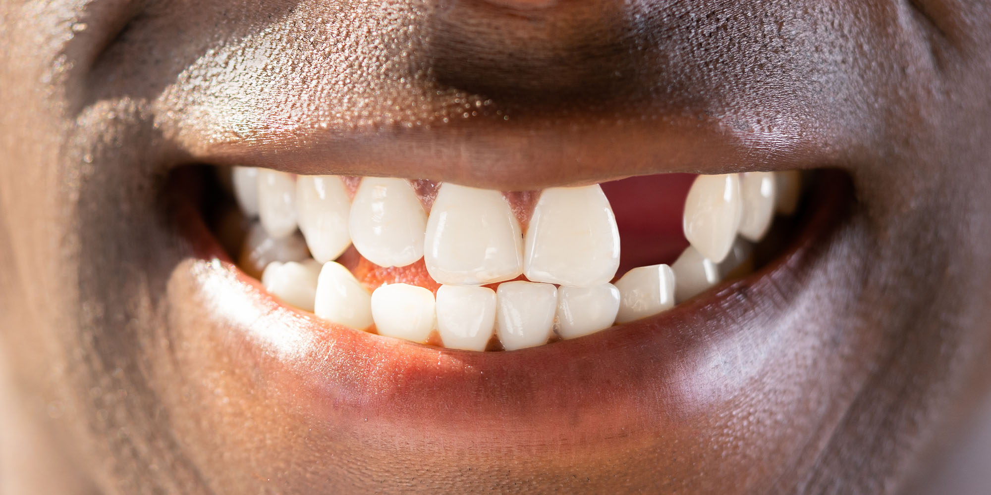 Replace Missing Teeth in Caerphilly