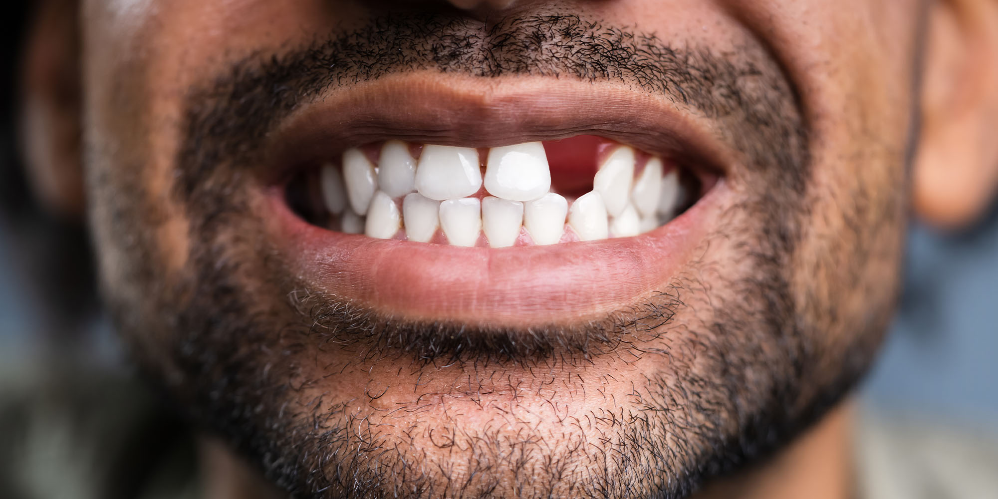 Are You Missing A Tooth? Here’s How to Get Your Smile Back!